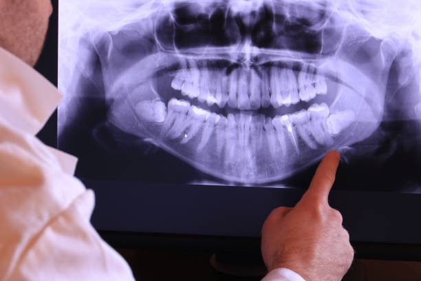 Best Emergency Wisdom Teeth Removal in Rouses Point, NY